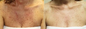 Before and After VI Peel Treatments